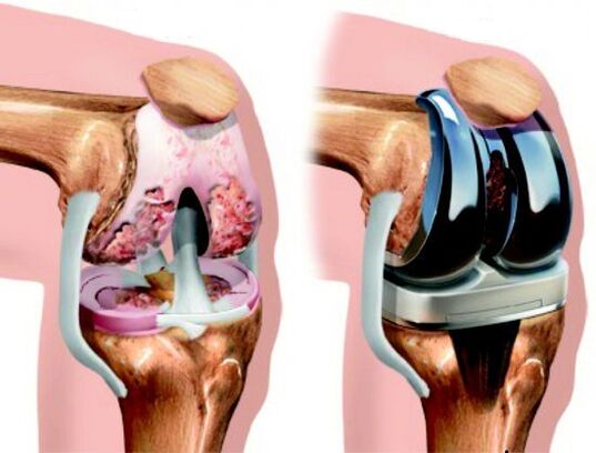 Results of knee replacement surgery for arthrosis