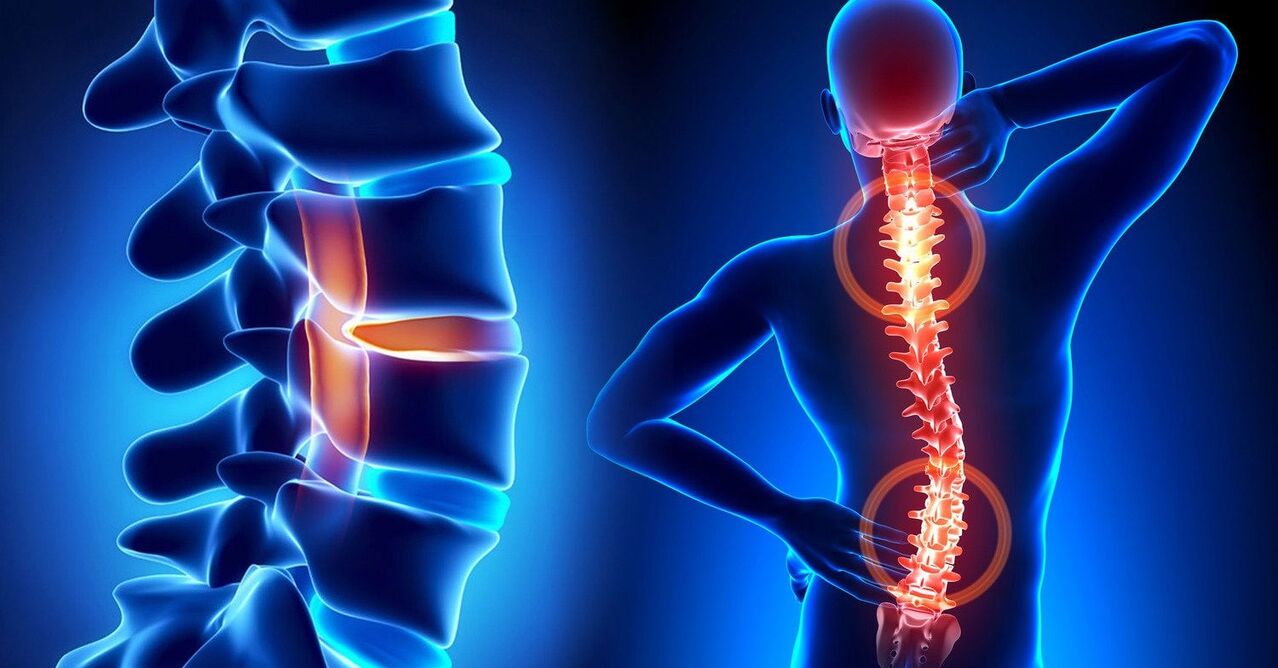 A sore spine leads to neck problems