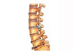 Stage of development of cervical osteochondrosis