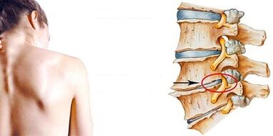 The developmental mechanism of cervical osteochondrosis