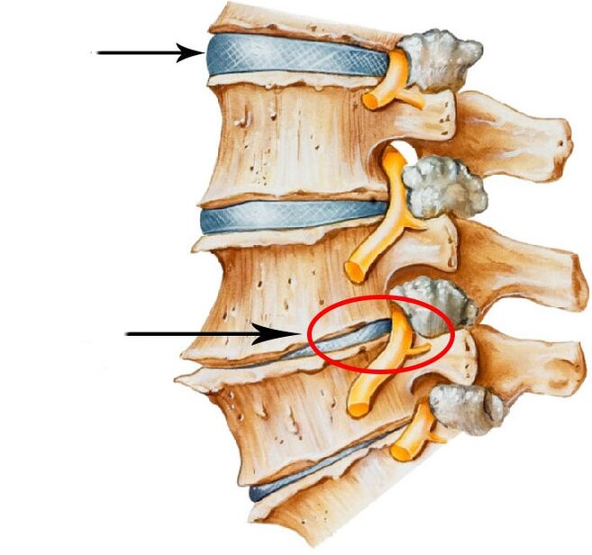 Development of disc hernia