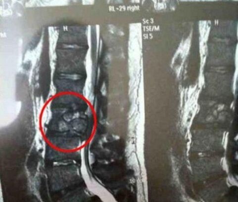Spinal tumor in the picture