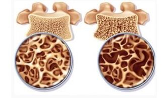 The dangers of cervical suction for women
