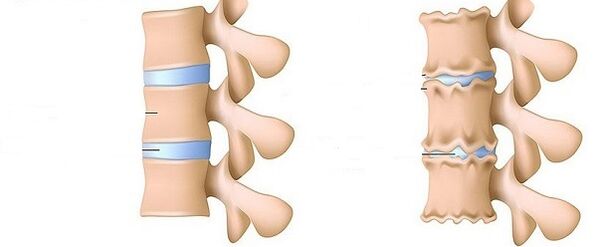 Spine and healthy osteochondrosis