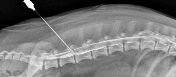 spinal restriction with osteochondrosis