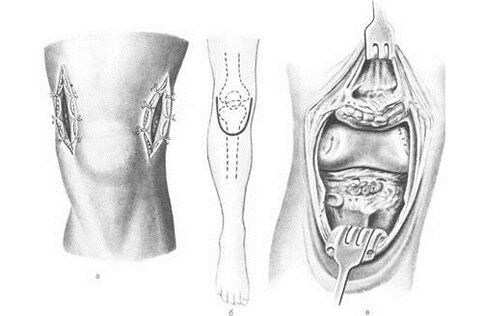 arthrotomy surgery for arthrosis